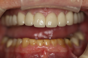 Smile Gallery Case Study 2 after porcelain crowns on all upper teeth