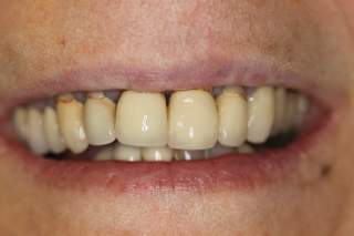 Smile Gallery Case 3 before with old crowns and recession line
