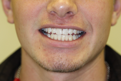 Smile Gallery Case 1 after simple Bondings and teeth whitening