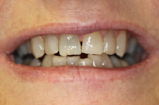 Smile Gallery Case 5 before with stained and crooked teeth