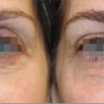 Case 1 Opus Plasma Before and After