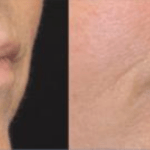Case 2 Opus Plasma Before and After around mouth