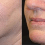 Case 1 Opus Plasma Before and After smile Lines