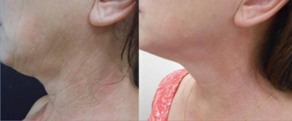 Case 4 Opus Plasma Before and After Neck area